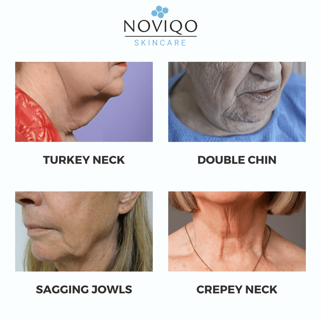 Noviqo™ – AH-8 Neck Firming Cream