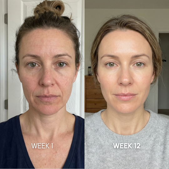 Noviqo™ – Collagen Renewal System
