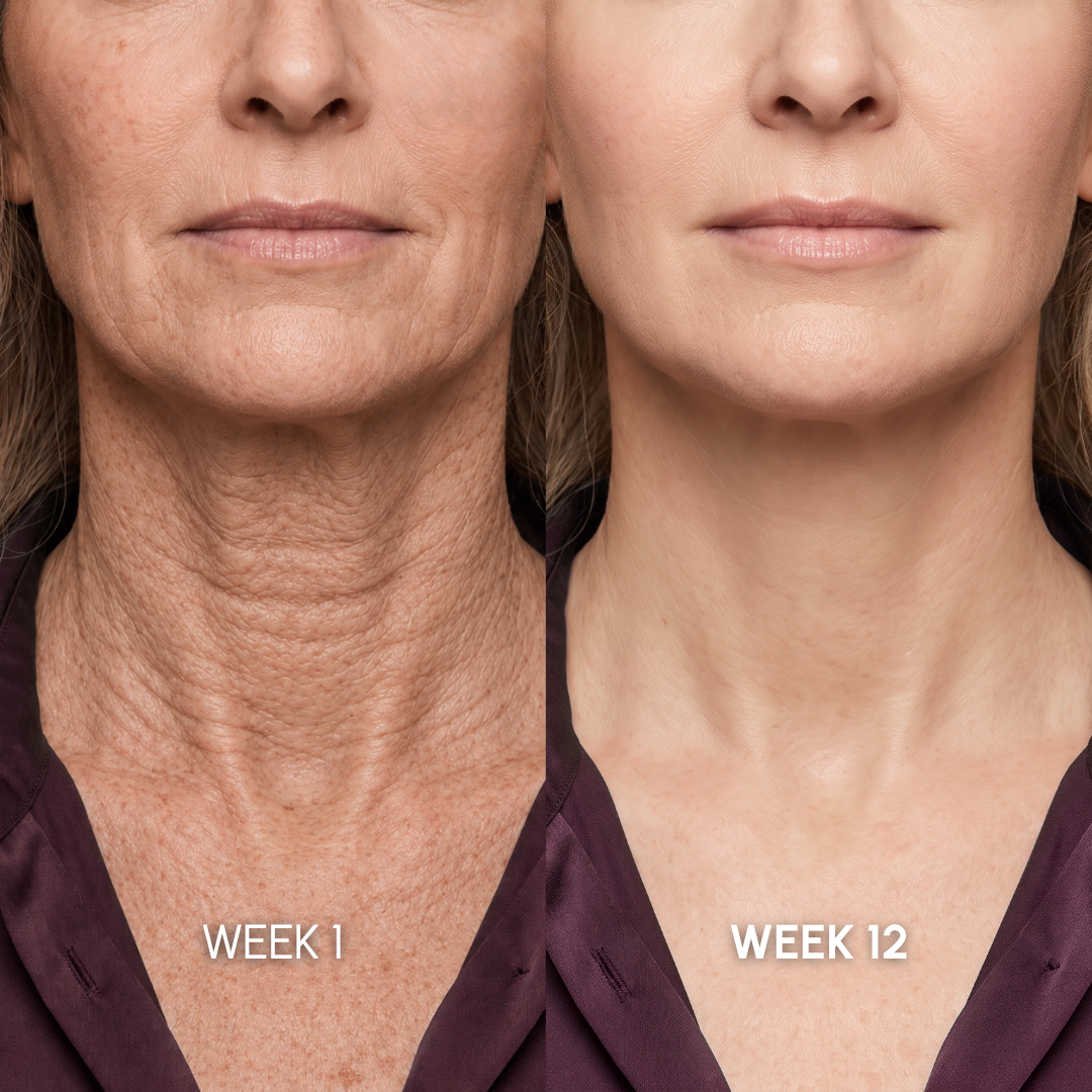 Noviqo™ – Neck Firming & Repair System (Gallery)